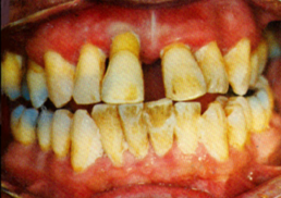 Periodontal disease, gum disease