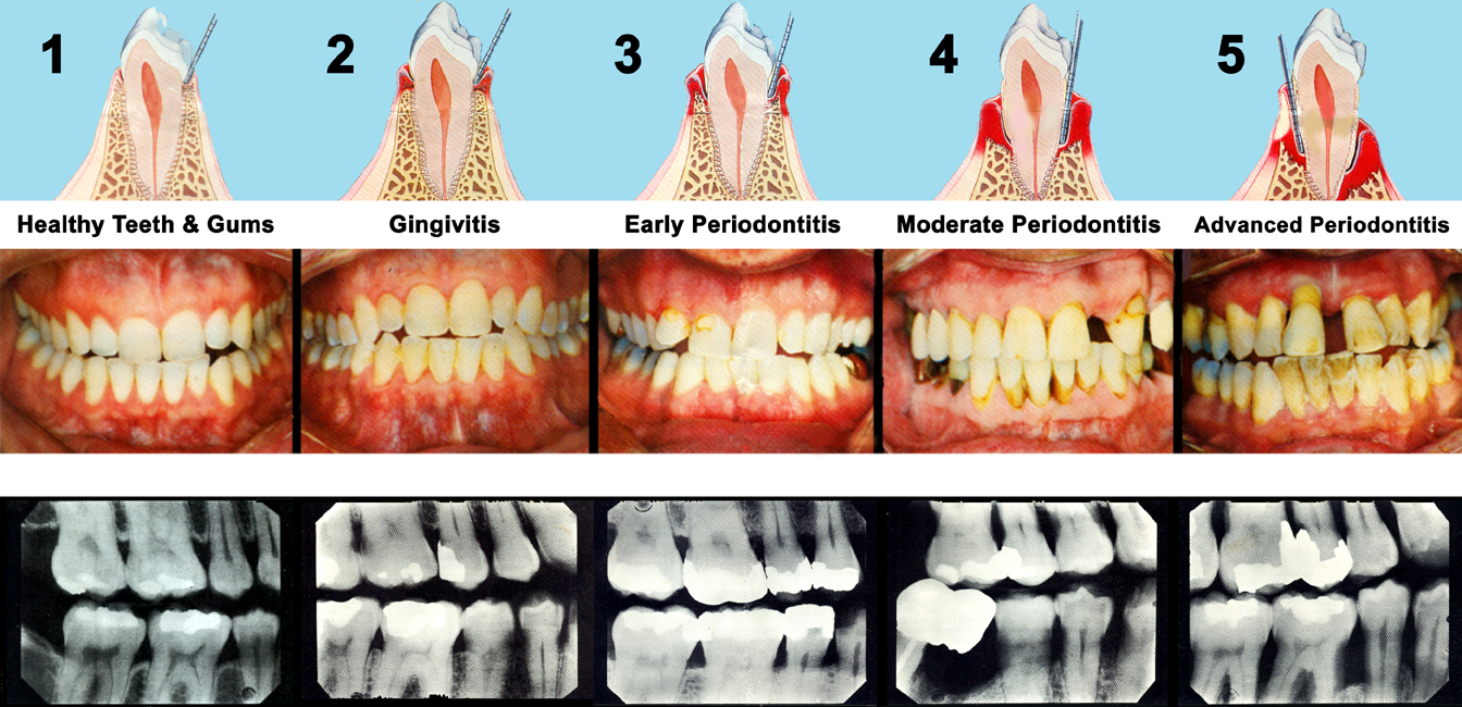 Stages of periodontal disease or gum disease